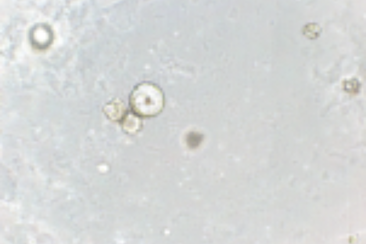 Organoid Construction | Pancreatic Cancer Organoid Culture Case